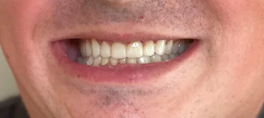 Smile Design μετά στο Smile Atelier