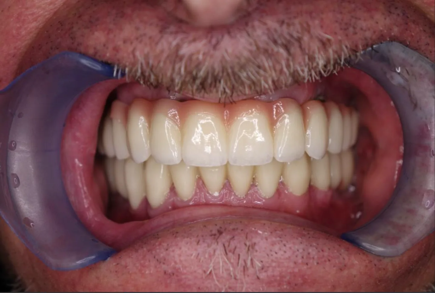 Μετά από θεραπεία veneers στο Smile Atelier Χαλκιδική